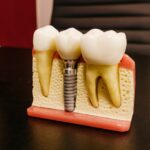 Oral Implants - Thinking About Go Abroad Regarding Dental Implants