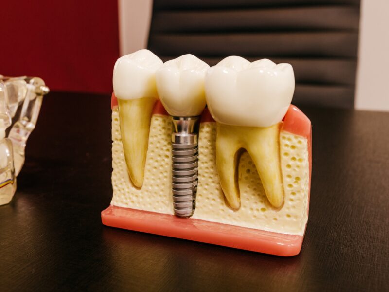 Oral Implants - Thinking About Go Abroad Regarding Dental Implants