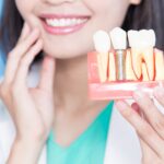 What Are The Cheapest Countries To Possess Dental Implants Abroad In 2023