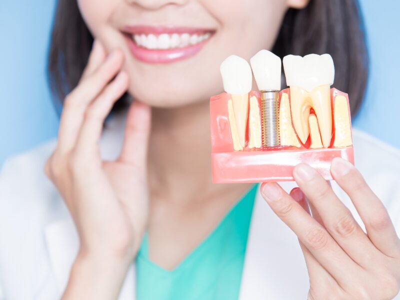 What Are The Cheapest Countries To Possess Dental Implants Abroad In 2023