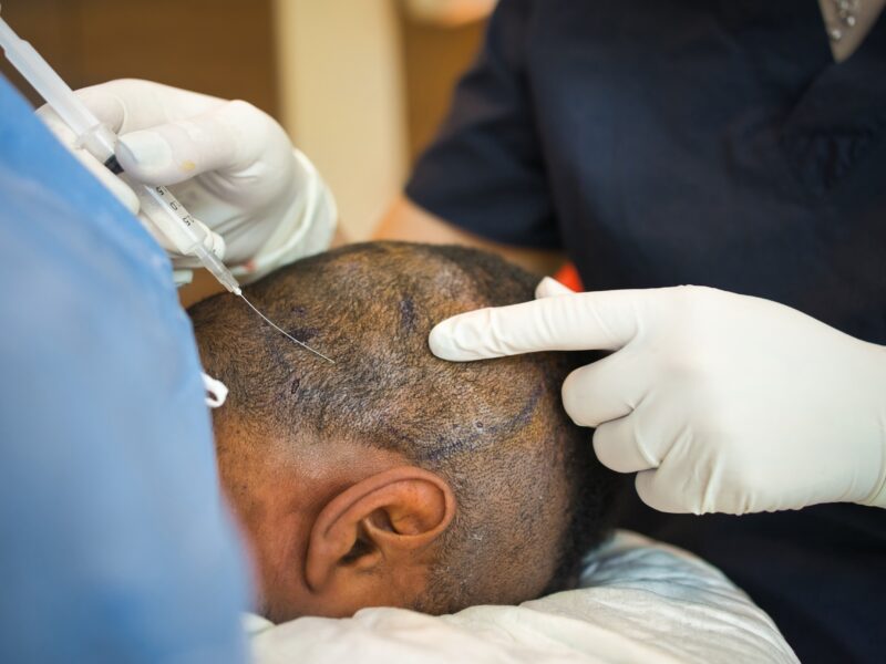 Hair Transplant Clinics & Surgeons in Istanbul Turkey