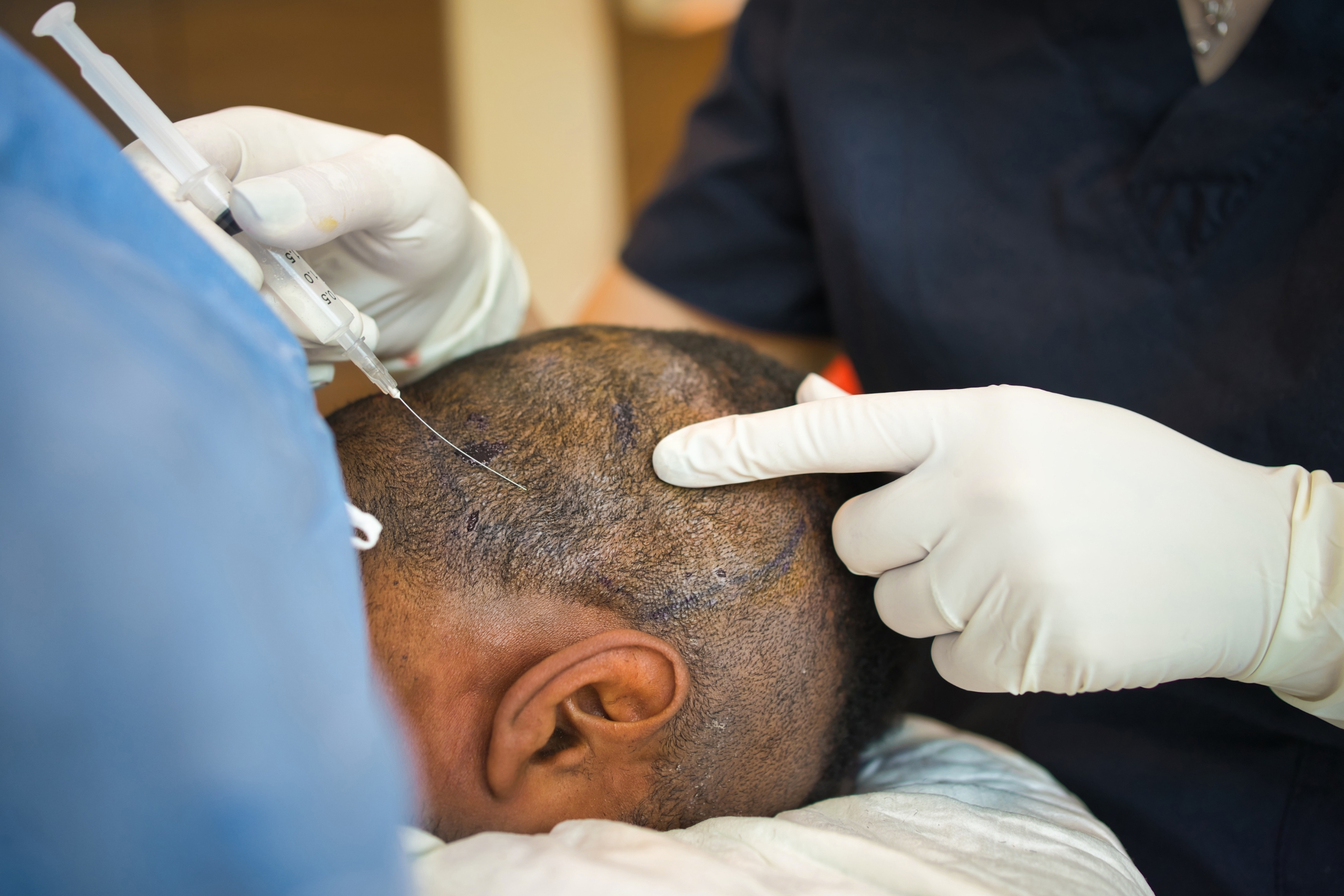 Hair Transplant Clinics & Surgeons in Istanbul Turkey