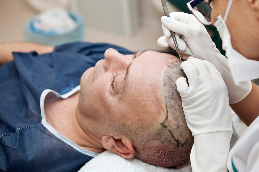 best hair transplant clinic in turkey